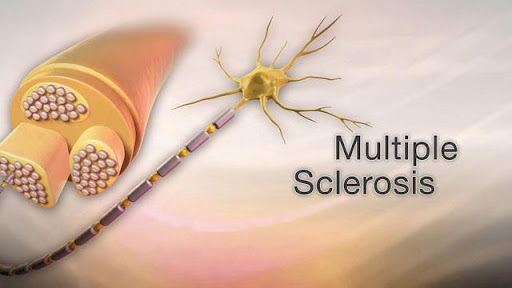 Sclerosis